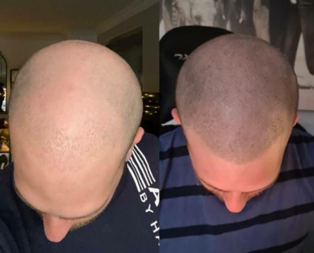 Scalp Micropigmentation